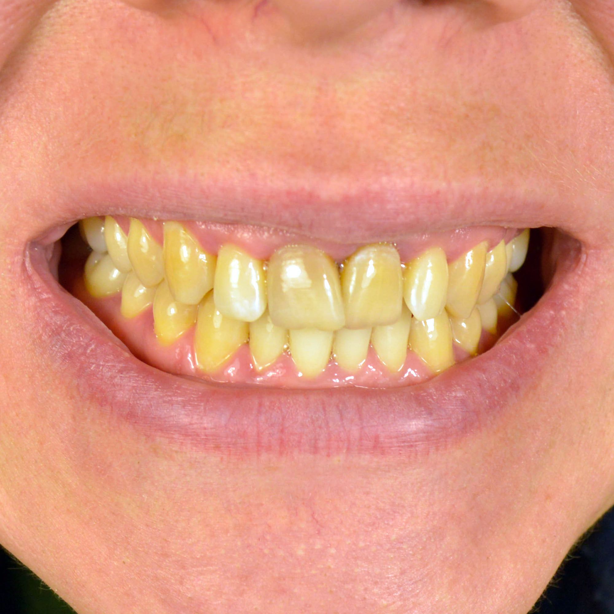 tooth Discoloration