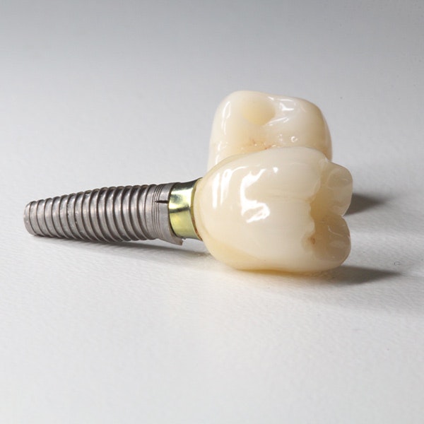 Implants and restorations 