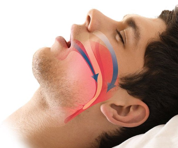 obstructive sleep apnea