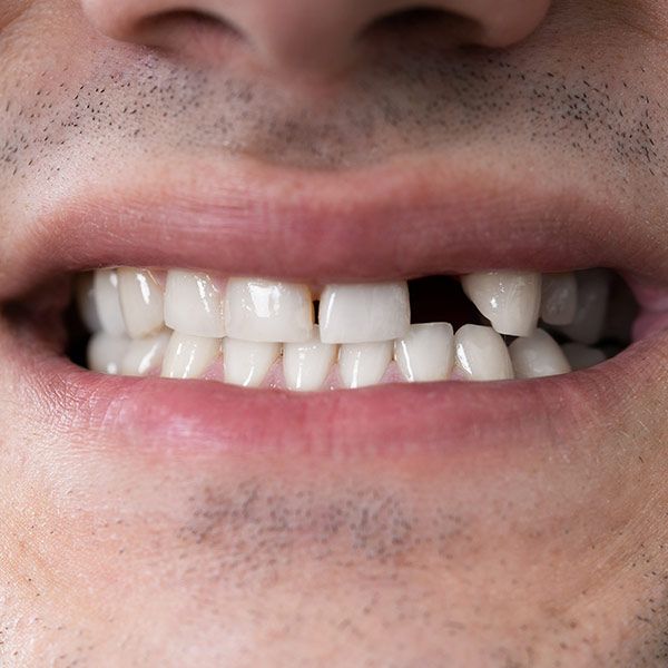 Missing tooth