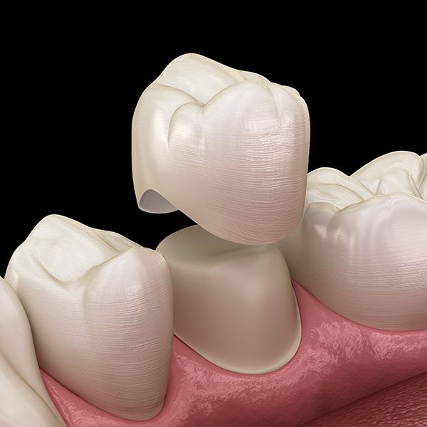 Dental Crowns