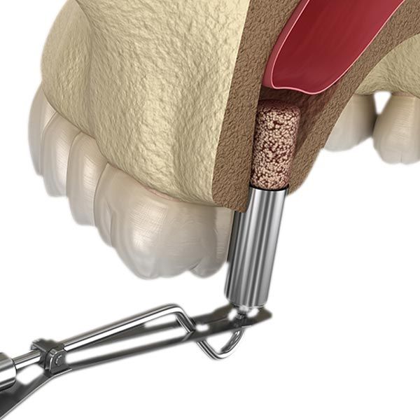 Illustration of the sinus lift