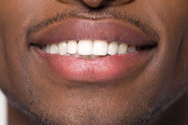Close up of teeth whitening